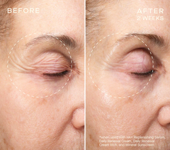Volume Recovery Set