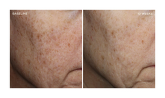 Collagen Reset Regimen